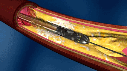 Image: The Jetstream G2 catheter, designed for thrombi removal in Peripheral Artery Disease (Photo courtesy of Pathway Medical).